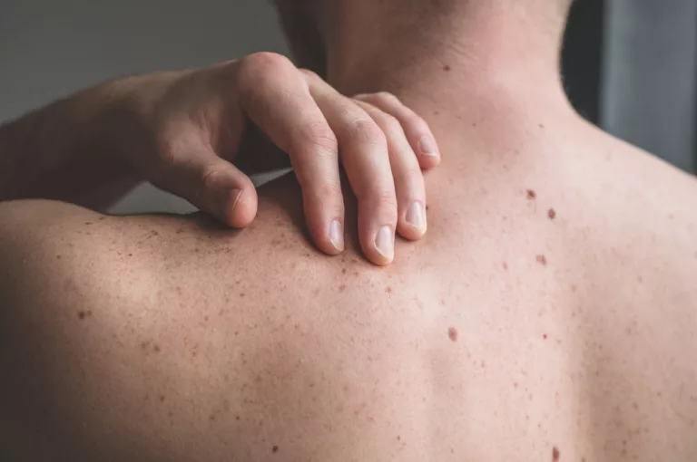Le cancer de la peau ?