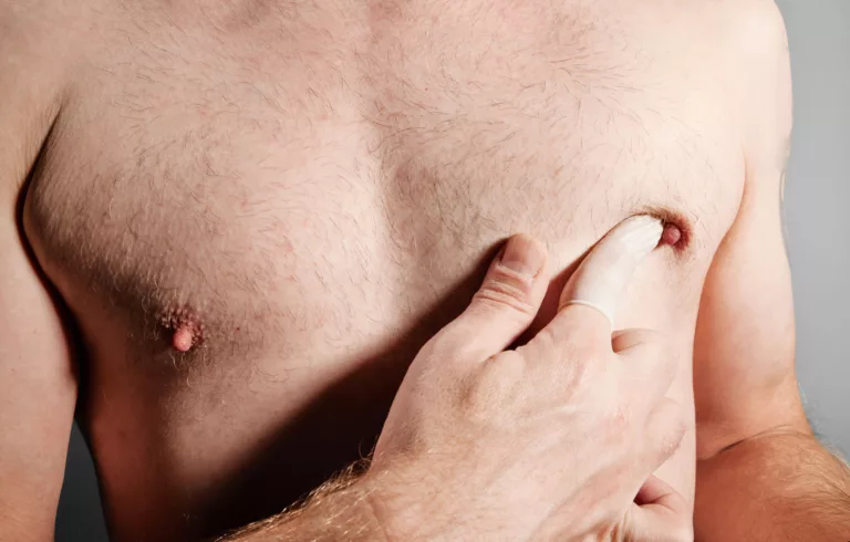 Cancer du sein chez l&rsquo;homme : un aperçu