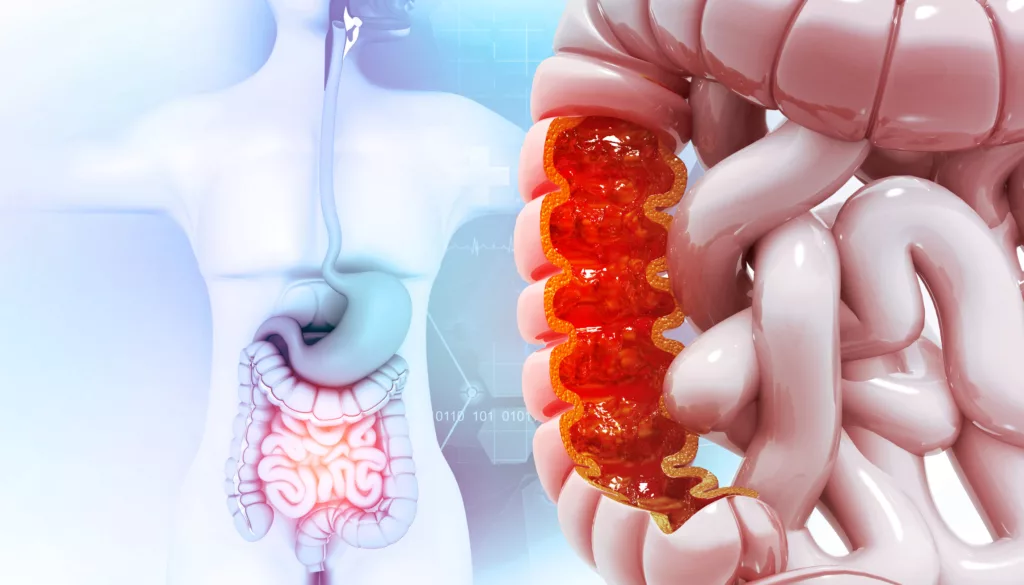 La greffe hépatique améliore les taux de survie en cas de cancer colorectal métastatique