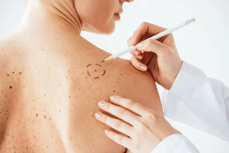 Augmentation des récidives du cancer de la peau : un appel à la vigilance