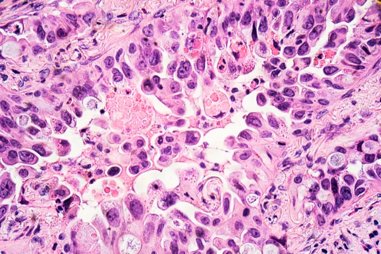 iTeos Therapeutics : Un espoir majeur dans le traitement du cancer du poumon