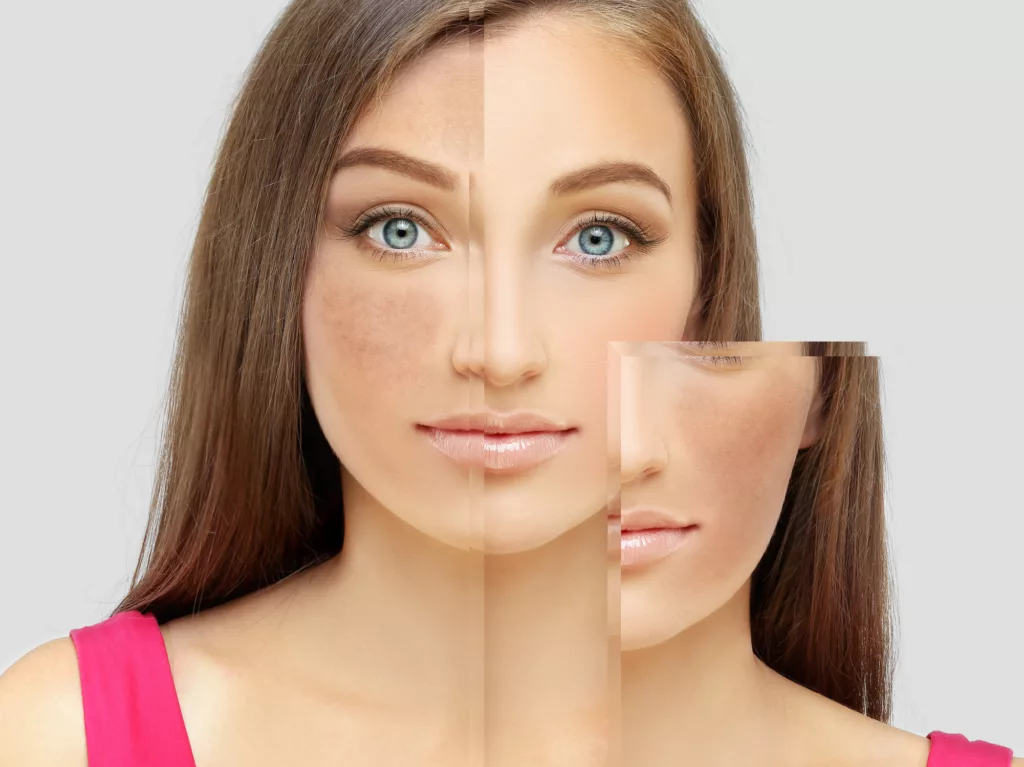 L&rsquo;hyperpigmentation cutanée : Un défi estival croissant