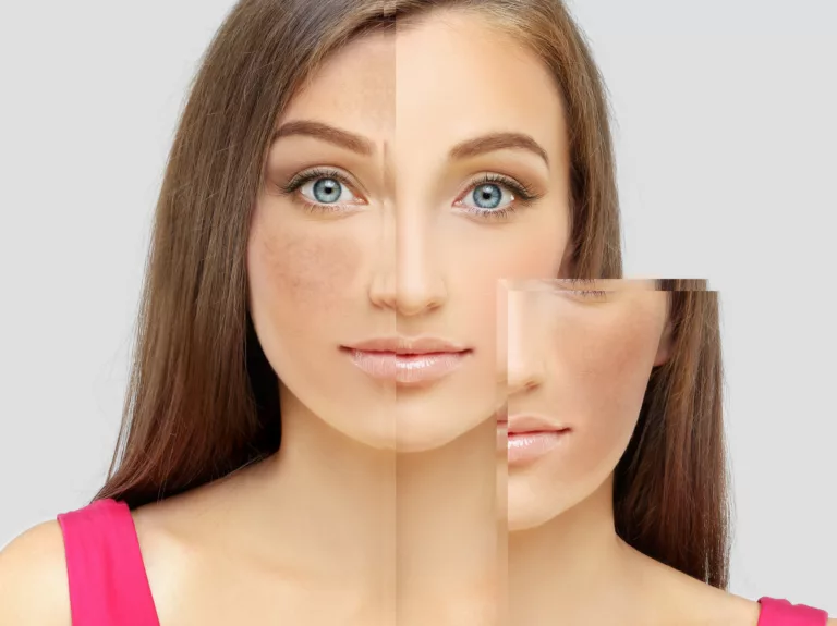 L&rsquo;hyperpigmentation cutanée : Un défi estival croissant
